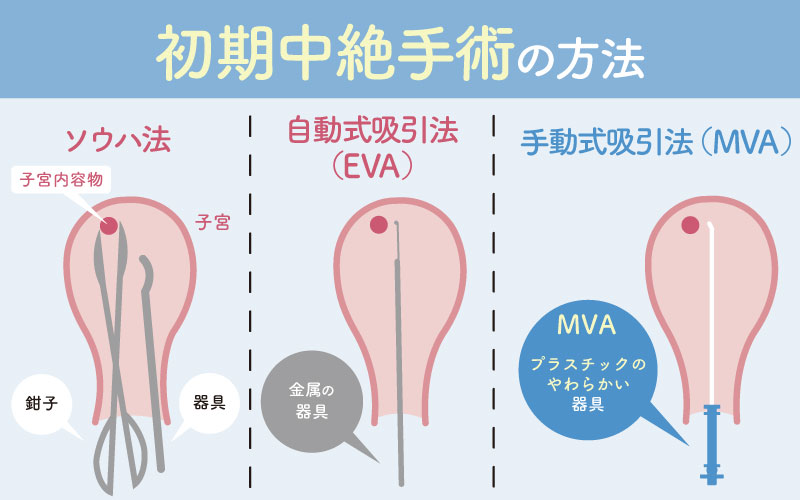 初期中絶手術の方法